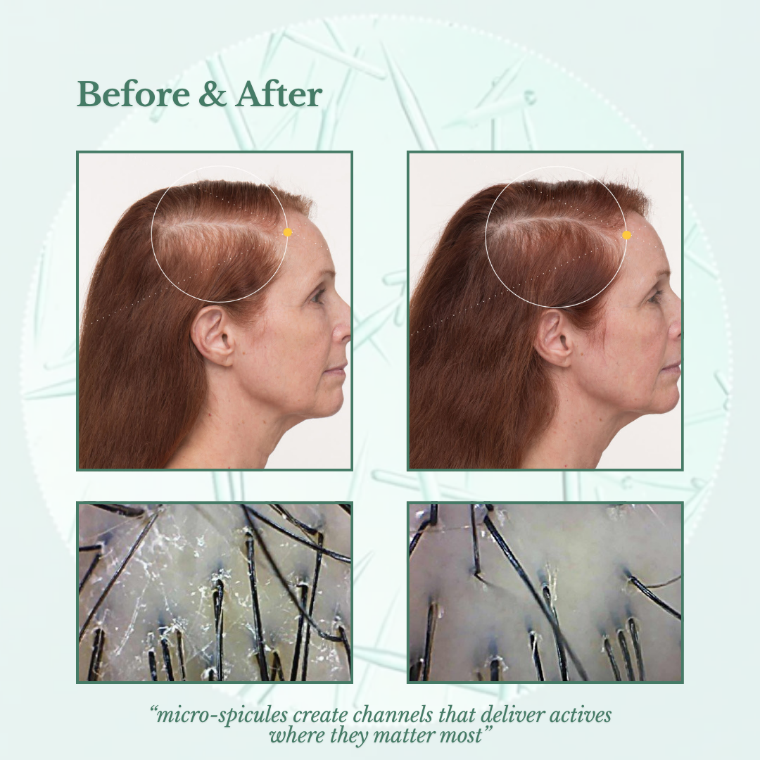 Korea's Viral Scalp Innovation: PDRN Reedle Shot™ Micro-Spicule Technology for Hair Regeneration